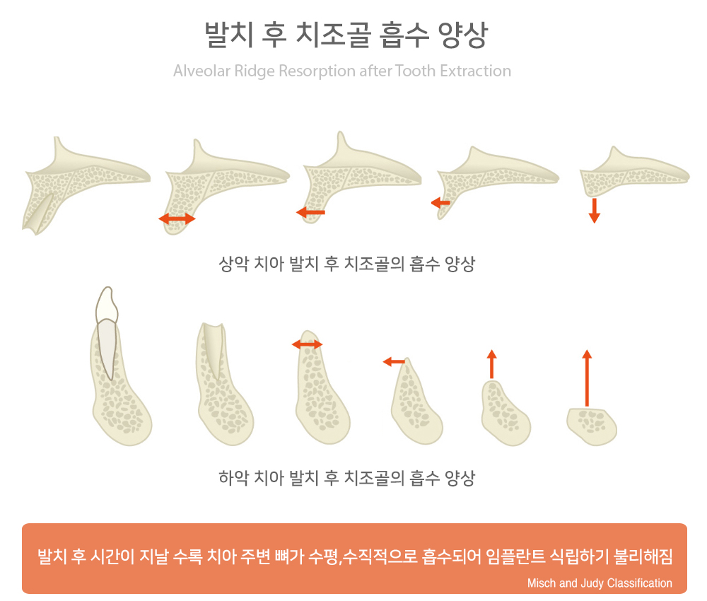 bonegraft2.jpg