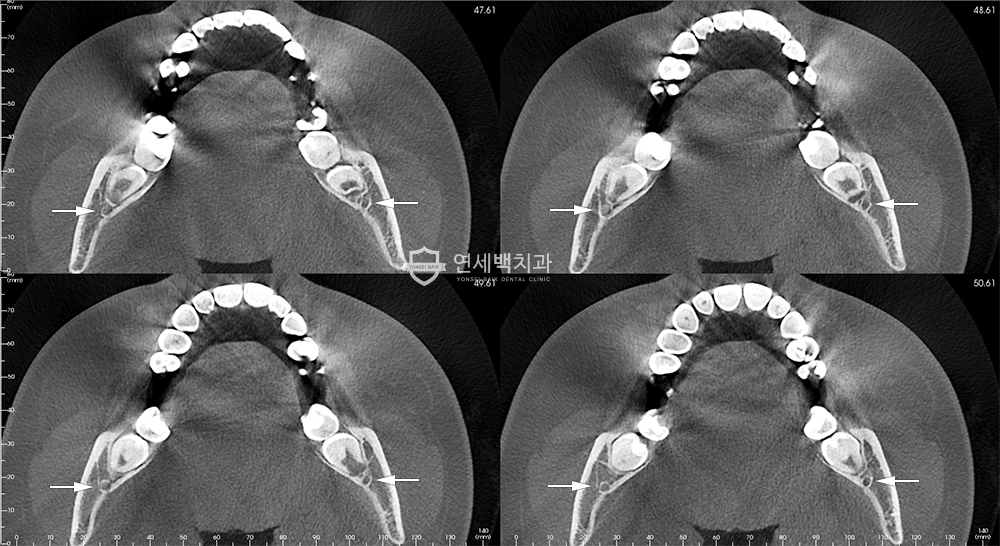 사랑니의 발치 시기는 언제야? 꼭 뽑아야 하나? 6