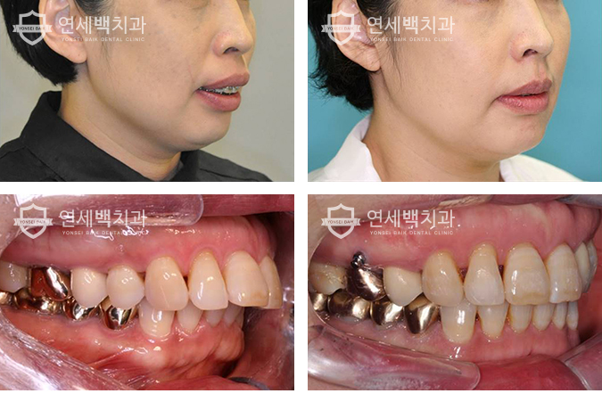 턱디스크, 턱교정 꼭 해주세요! 턱빠짐 턱걸이 장애 턱교정기 비용, 관리방법! 4