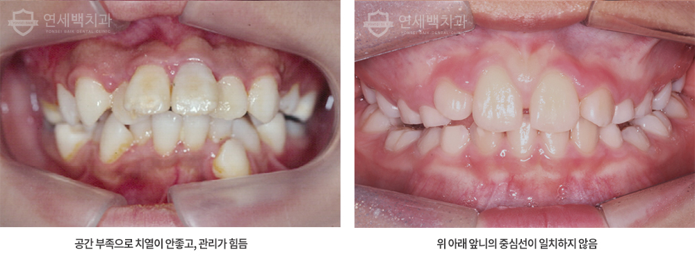 어금니교합 돌출구헤라 턱이 벌어진 앞니, 부정교합 종류 5