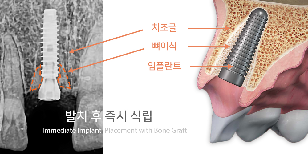 연세백치과 칼럼 - 임플란트 골이식술 #1: 어떤 경우에 뼈이식을 하나요? 연세백치과 칼럼 - 임플란트 골이식술 #1: 어떤 경우에 뼈이식을 하나요?