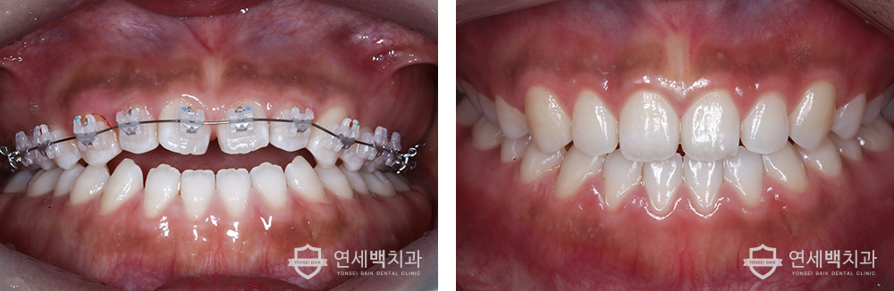 어금니교합 돌출구헤라 턱이 벌어진 앞니, 부정교합 종류 2