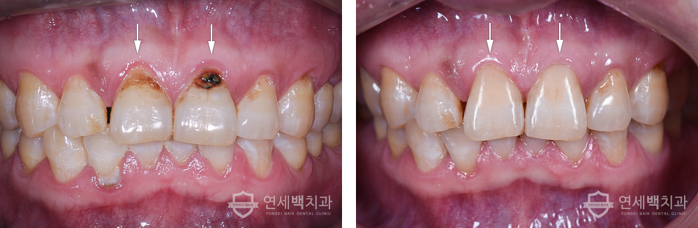 연세백치과 칼럼 - 치아가 시려요 / 치아가 파였어요