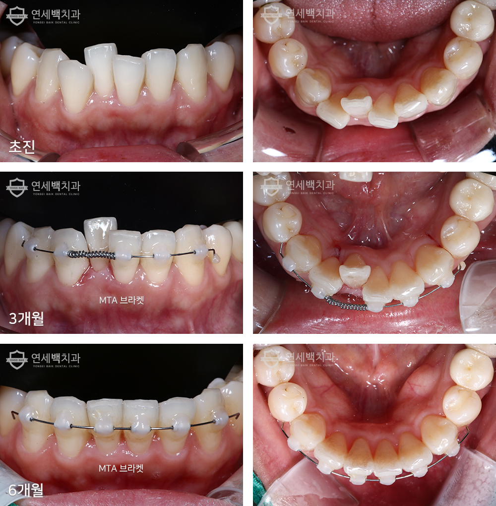 마곡앞니 교정이 이루어진 치아, 왜소치아 치료방법, 앞니 교정비용, 전체
