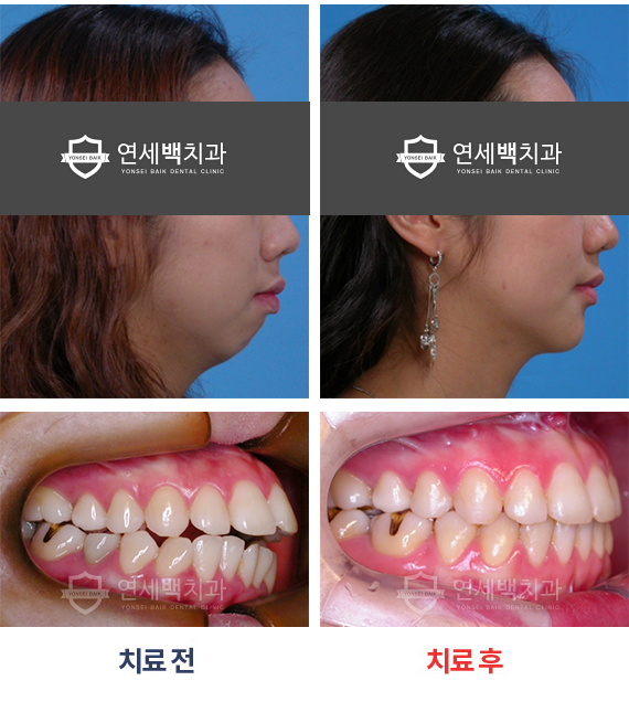 치료사진 - 수술 교정 (무턱)