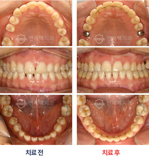 예당마을 치과교정 후 이렇게 케어해주세요!