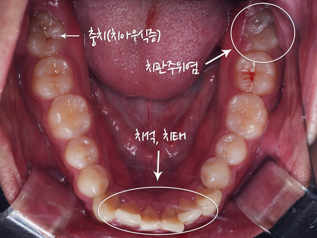 치과임상사진