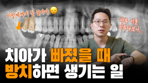 빠진 치아 방치하면 큰일나요 | 치아가 내려와서 임플란트할 공간이 없데요 | 대합치 정출 시 치료 방법