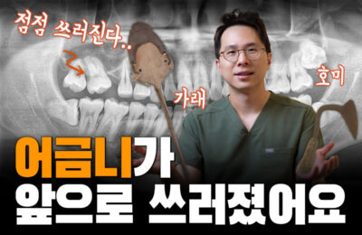 빠진 치아를 방치하면 발생하는 문제 | 어금니가 앞으로 쓰러졌어요.