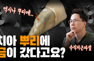 치아 뿌리에 금이 갔다고요? | 수직치근파절
