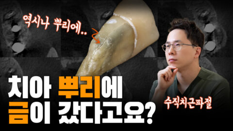 치아 뿌리에 금이 갔다고요? | 수직치근파절