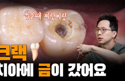 치아에 금이 갔어요 | 씹을 때 찌릿하게 아파요
