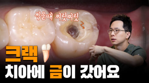 치아에 금이 갔어요 | 씹을 때 찌릿하게 아파요