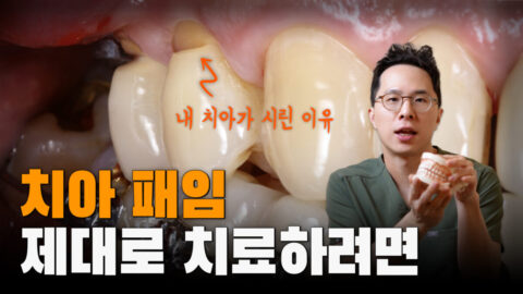 치아패임 제대로 치료하려면? | 치경부파절증 | 치아가 시려요