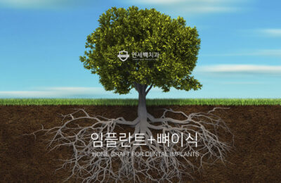 임플란트 골이식술 #1: 어떤 경우에 뼈이식을 하나요?