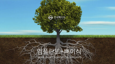 임플란트 골이식술 #1: 어떤 경우에 뼈이식을 하나요?