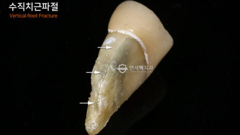 수직치근파절: 치아 뿌리에 금이 갔어요.