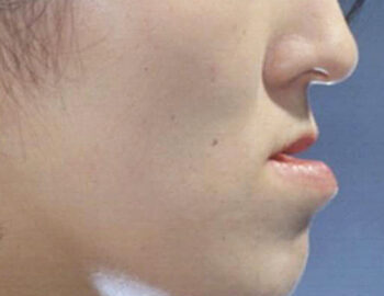 주걱턱 교정치료는 어떻게 하나요?