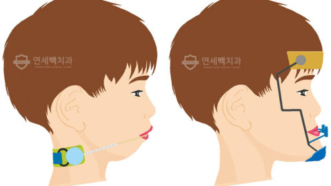 교정치료, 언제 시작하는 것이 좋은가요?