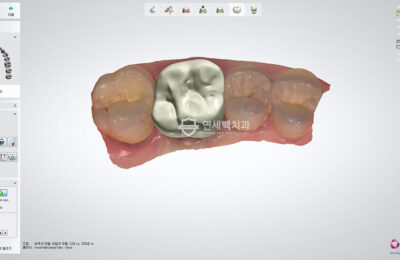 캐드캠(CAD/CAM) 시스템을 이용한 보철물(크라운) 제작