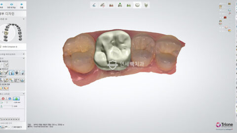캐드캠(CAD/CAM) 시스템을 이용한 보철물(크라운) 제작